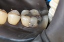Frank Fukuda #30 pre-op buccal