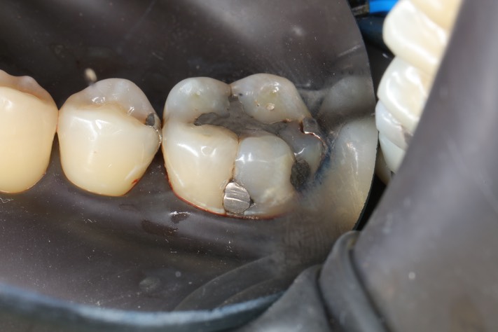 Frank Fukuda #30 pre-op buccal 2
