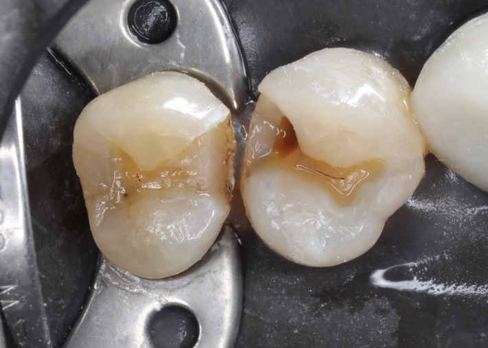 Gary Umeda #12-13 amalgam removal