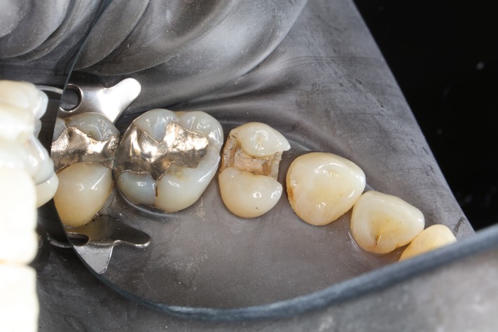 Gary Umeda #13 caries removal