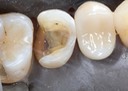 Gary Umeda #13 casting removal