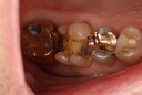 Gary Umeda #2-3 pre-op