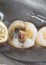 Gary Umeda #30 crown removal