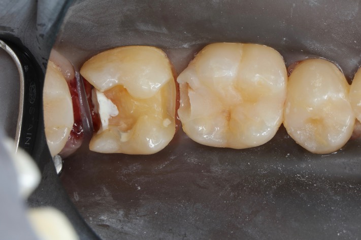 Gary Umeda #30 pre-op