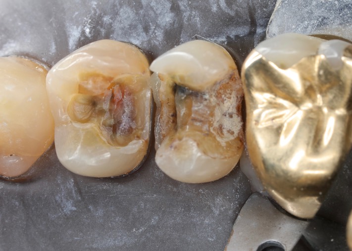 Gary Umeda #4 & 5 caries removal