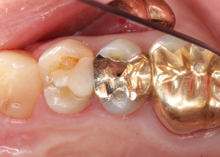 Gary Umeda #4 & 5 pre-op