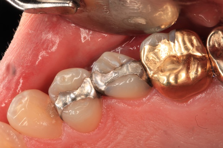 Gary Umeda #4,5,6 pre-op