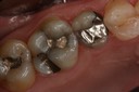 Gary Umeda #13-14 pre-op