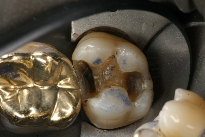 Russ Tabata #2 caries removal