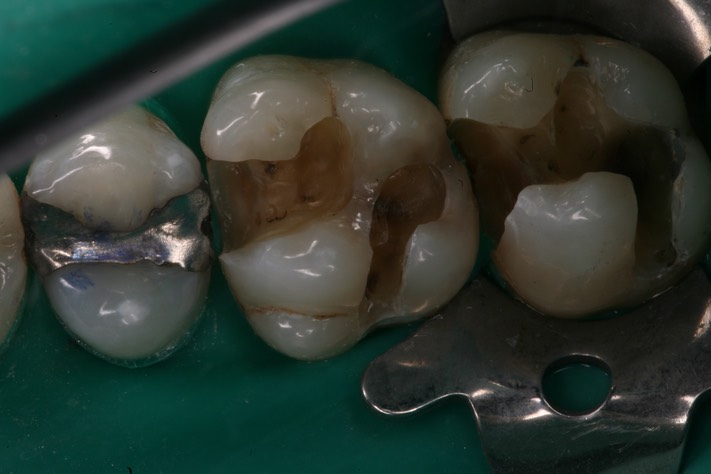 Ted Kanamori #2-3 caries removal