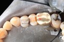 Russ Tabata #4 composite removal