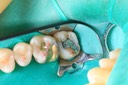 Mendel Sato #2 pre-op