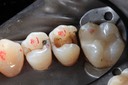 Frank Fukuda #4 amalgam removal
