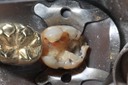 Alan Tamashiro #18 amalgam removal