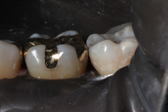 Wayne Chin #19 buccal view