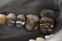Alan Tamashiro #3 amalgam removal