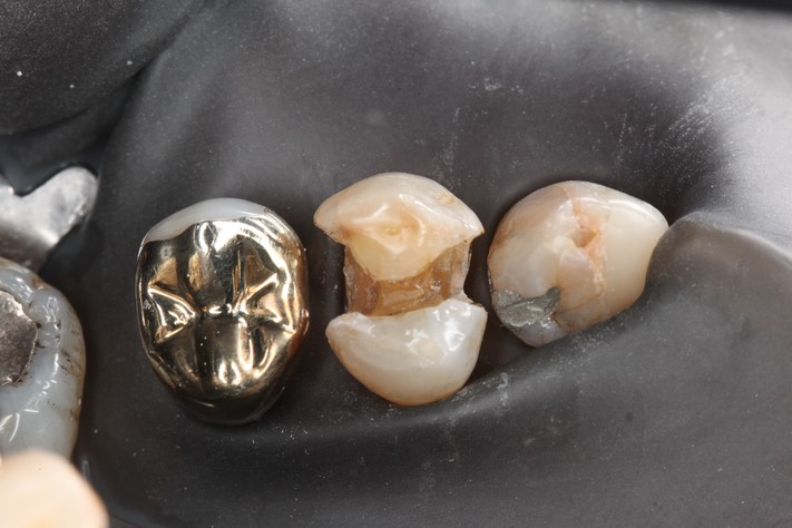 Alan Chinn #12 amalgam removal