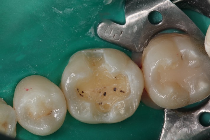 Wes Sato #19 composite removal