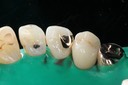 Mark Chun #6 cementation