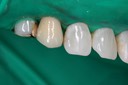Mark Chun #6 labial view