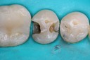 Mitchell Chun #29 amalgam removal