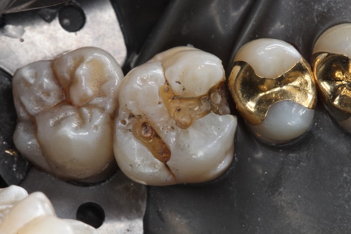 Steph Wong #14 amalgam removal