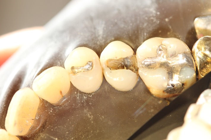 Nina Hayashi #4 amalgam removal