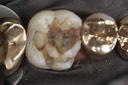 Larry Fujioka #14 amalgam removal