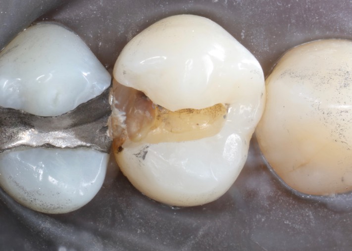 Joe Cha #12 caries removal
