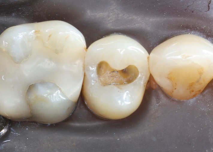 Joe Cha #13 amalgam removal