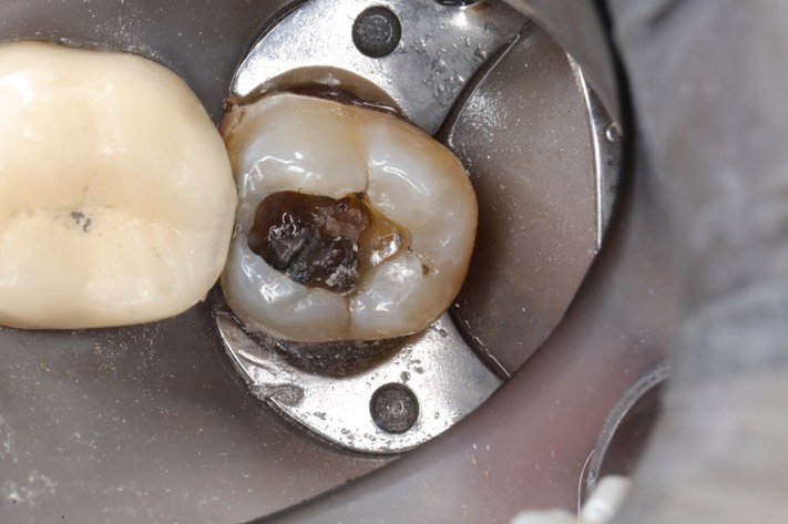 Joe Cha #18 amalgam removal