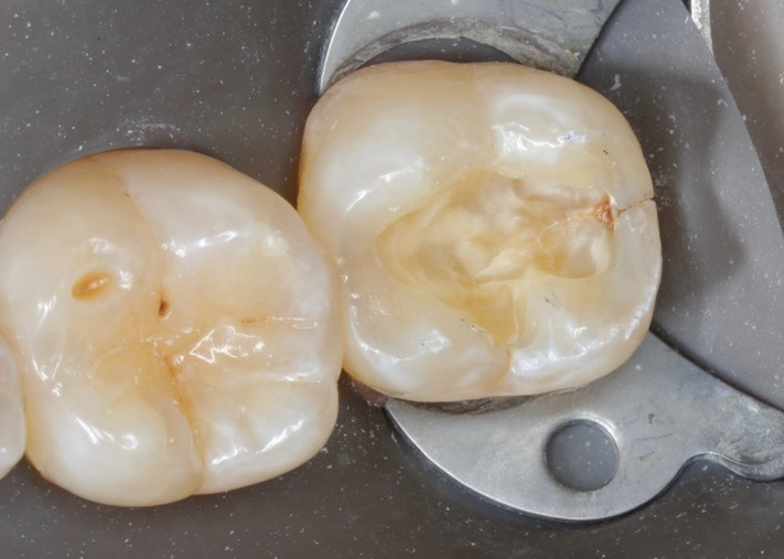 Joe Cha #18 composite removal