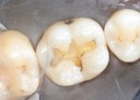 Joe Cha #30 amalgam removal