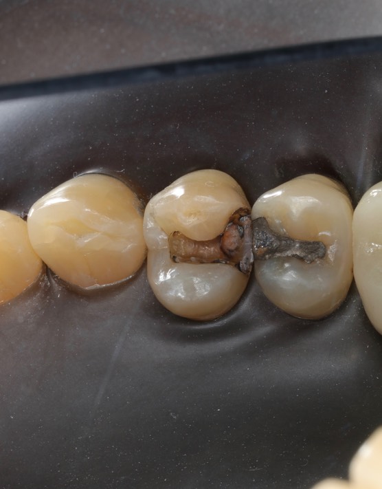 Joe Cha #5 amalgam removal