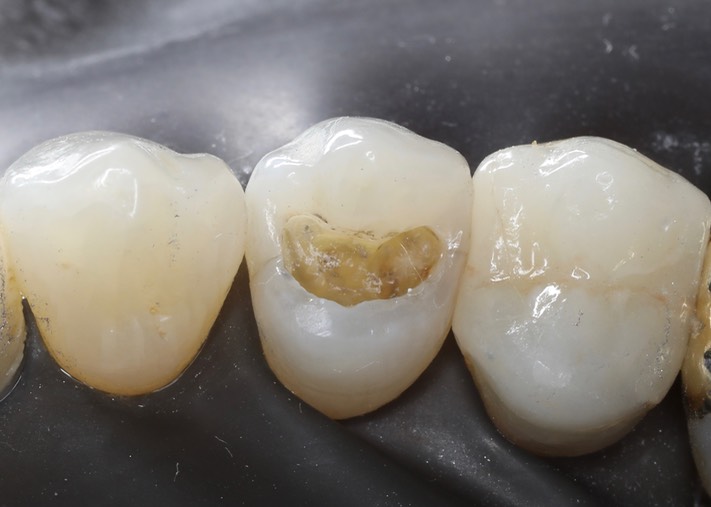 Joe Cha #5 amalgam removal