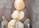 Kris Nip #13 caries removal 