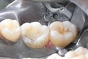 Kris Nip #19 prep lingual view
