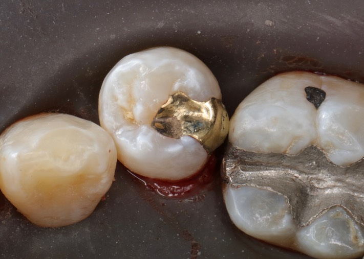 Kris Nip #20 pre-cementation