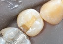 Kris Nip #29 amalgam removal