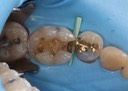 Kris Nip #30 amalgam removal