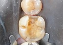 Kris Nip #30 caries removal