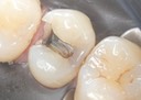 Kris Nip #4 caries removal