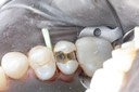 Kris Nip #4 caries removal