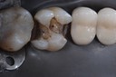 Kyle Chock #14 amalgam removal