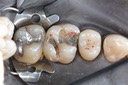 Kyle Chock #14 caries removal