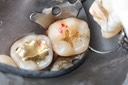 Kyle Chock #18 amalgam removal