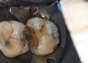 Kyle Chock #2 amalgam removal