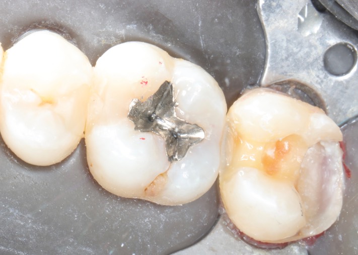 Kyle Chock #2 caries removal