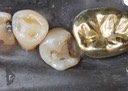 Kyle Chock #20 amalgam removal