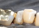 Kyle Chock #20 buccal view